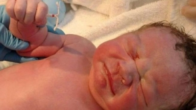 Un bebé nace con el DIU que tenía su madre en la mano